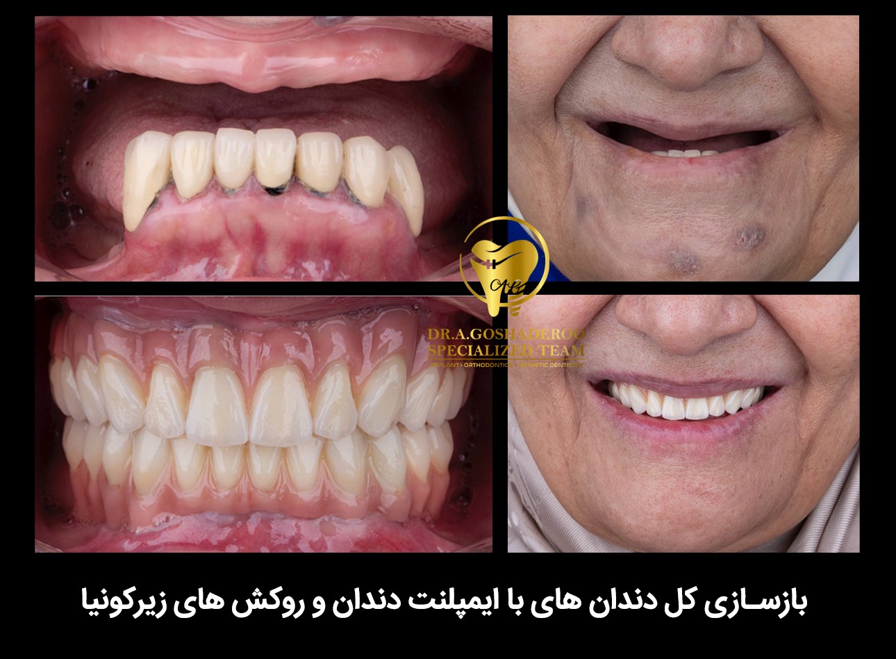 ایمپلنت دندان برای افراد دیابتی
